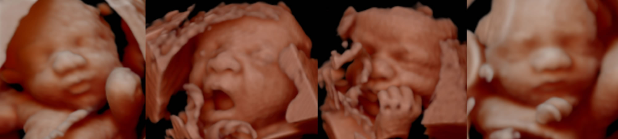 donde hacer scan fetal capital